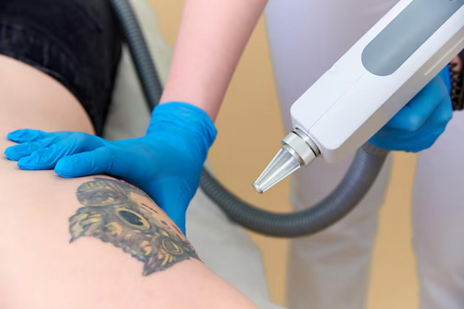Is Laser Tattoo Removal Permanent?